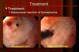 Treatment
 Treatment
   Submucosal   injection of Epinepherine




   Duodenal Ulcer                 Injection Therapy
 
