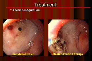 Treatment
 Thermocoagulation




 Duodenal Ulcer          Heater Probe Therapy
 