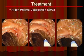 Treatment
 Argon   Plasma Coagulation (APC)
 