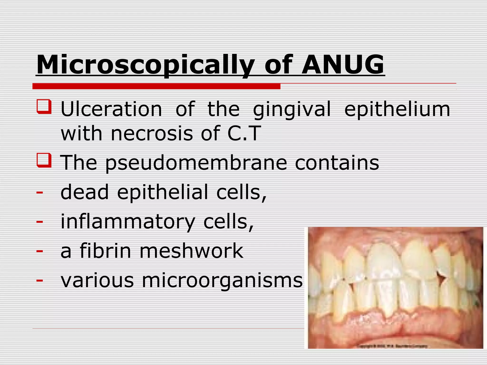 Acute Gingival Conditions PPT