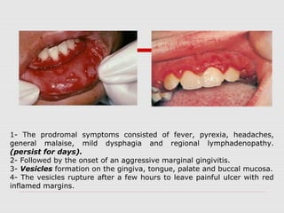 1- The prodromal symptoms consisted of fever, pyrexia, headaches,
general malaise, mild dysphagia and regional lymphadenopathy.
(persist for days).
2- Followed by the onset of an aggressive marginal gingivitis.
3- Vesicles formation on the gingiva, tongue, palate and buccal mucosa.
4- The vesicles rupture after a few hours to leave painful ulcer with red
inflamed margins.
 