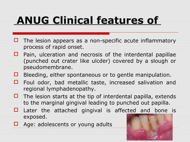 Acute gingival conditions | PPT | Dental Health | Diseases and Conditions