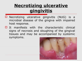 Necrotizing Ulcerative Gingivitis Before And After