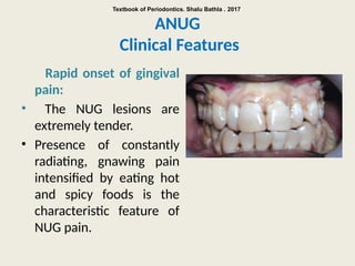 Acute Gingival Conditions.Pptx dentistry | PPTX