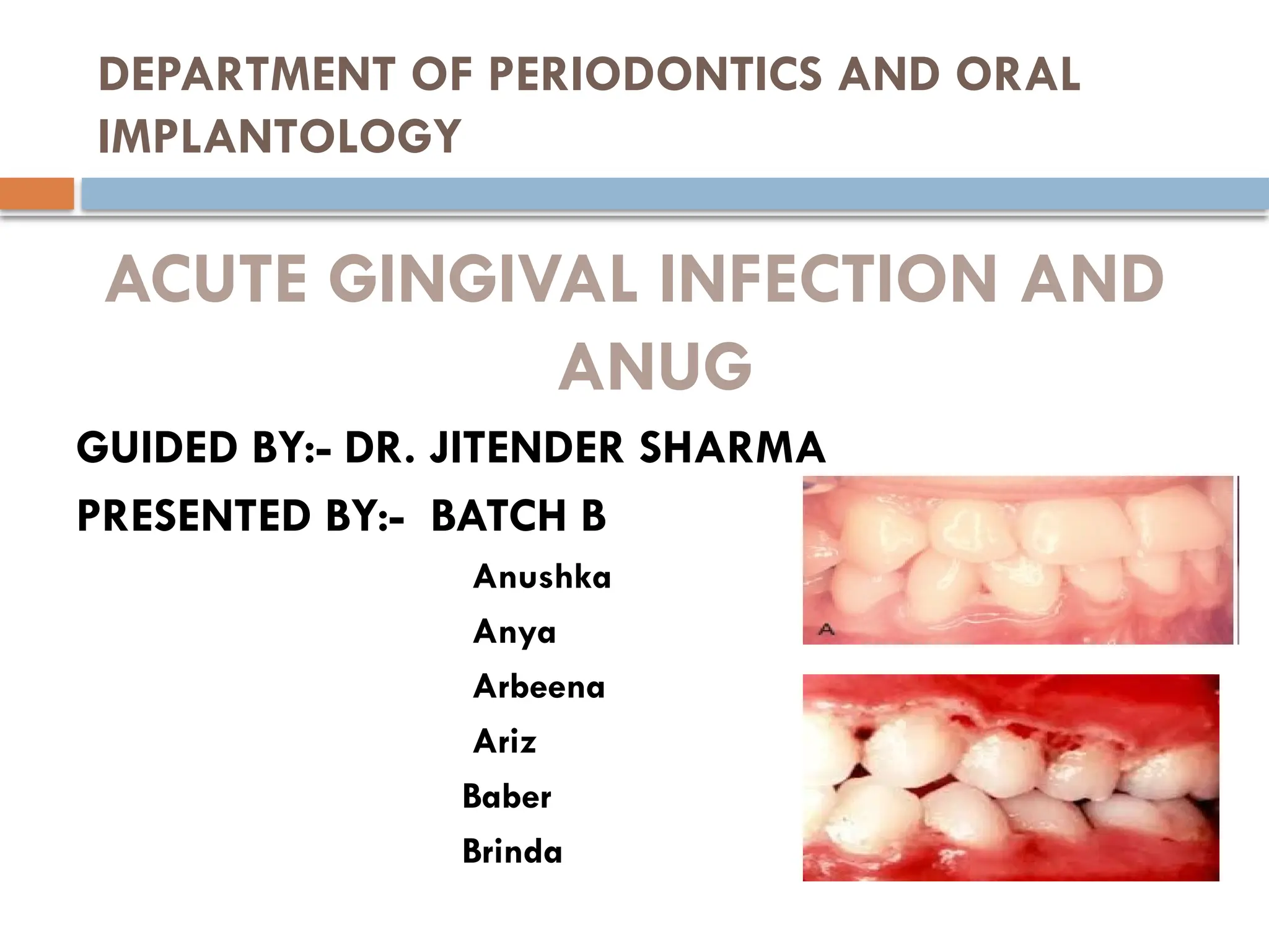 ACUTE_GINGIVAL_INFECTION 0019847363647466363 | PPTX
