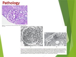 ACUTE_GLOMERULONEPHRITIS IS A COMMON RENAL DISORDER IN PEADIATRICS | PPTX