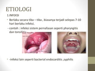 ETIOLOGI
1.INFEKSI
• Berlaku secara tiba – tiba , biasanya terjadi selepas 7-10
hari berlaku infeksi.
- contoh : infeksi sistem pernafasan seperti pharyngitis
dan tonsillitis

• -infeksi lain seperti bacterial endocarditis ,syphilis

 