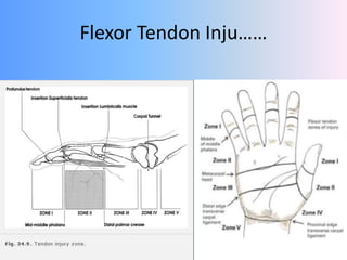 acute-hand-injury-management-pptx