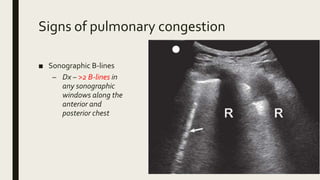 Acute heart failure [MBBS] | PPTX