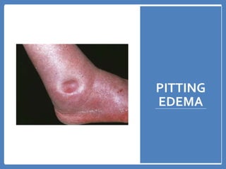 PITTING
EDEMA
 