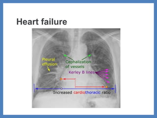 Heart failure
 