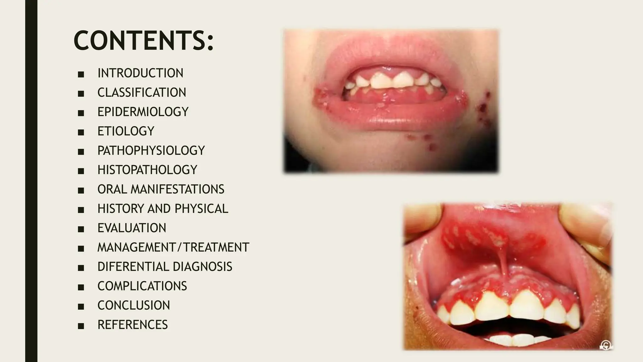 Acute Herpetic Gingivostomatitis Oral Signs And Symptoms