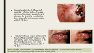 Acute Herpetic Gingivostomatitis 1 pptx acute-herpetic-gingivostomatitis-1-pptx