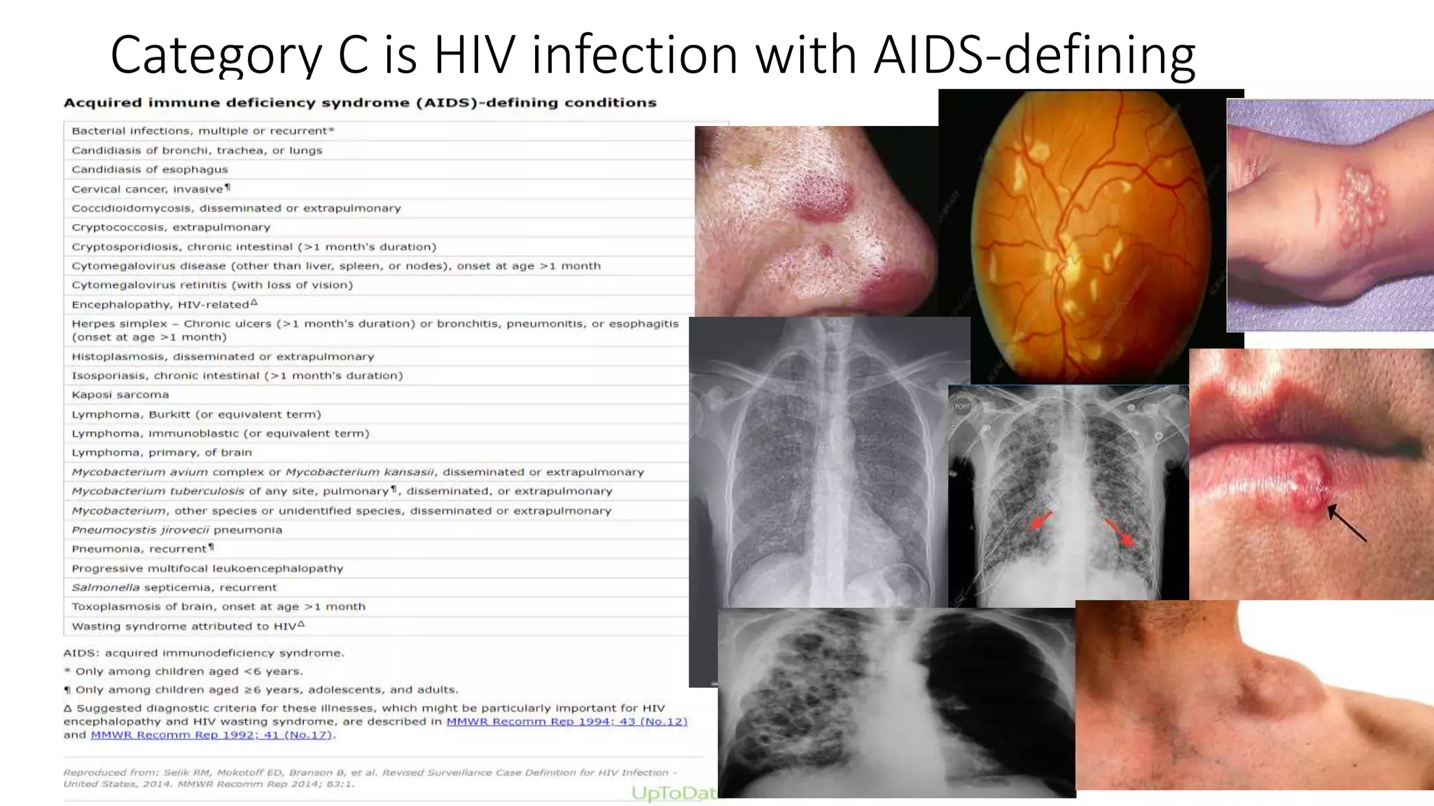 Category C is HIV infection with AIDS-defining
opportunistic infections
 