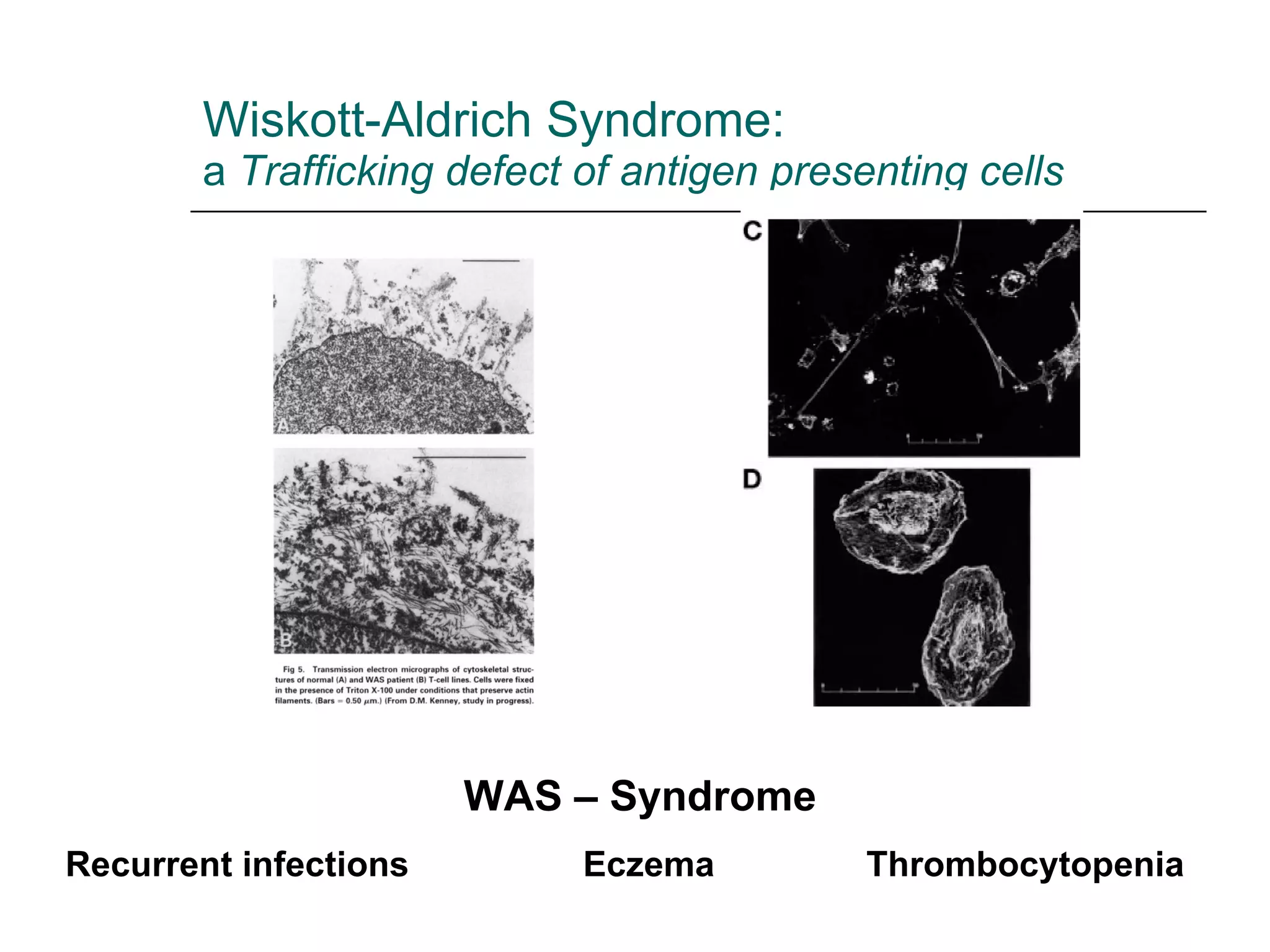 Wiskott-Aldrich Syndrome: a  Trafficking defect of antigen presenting cells WAS – Syndrome Recurrent infections   Eczema   Thrombocytopenia 