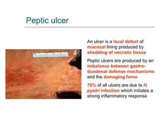 Peptic ulcer An ulcer is a  local defect  of  mucosal  lining produced by  shedding of necrotic tissue Peptic ulcers are p...