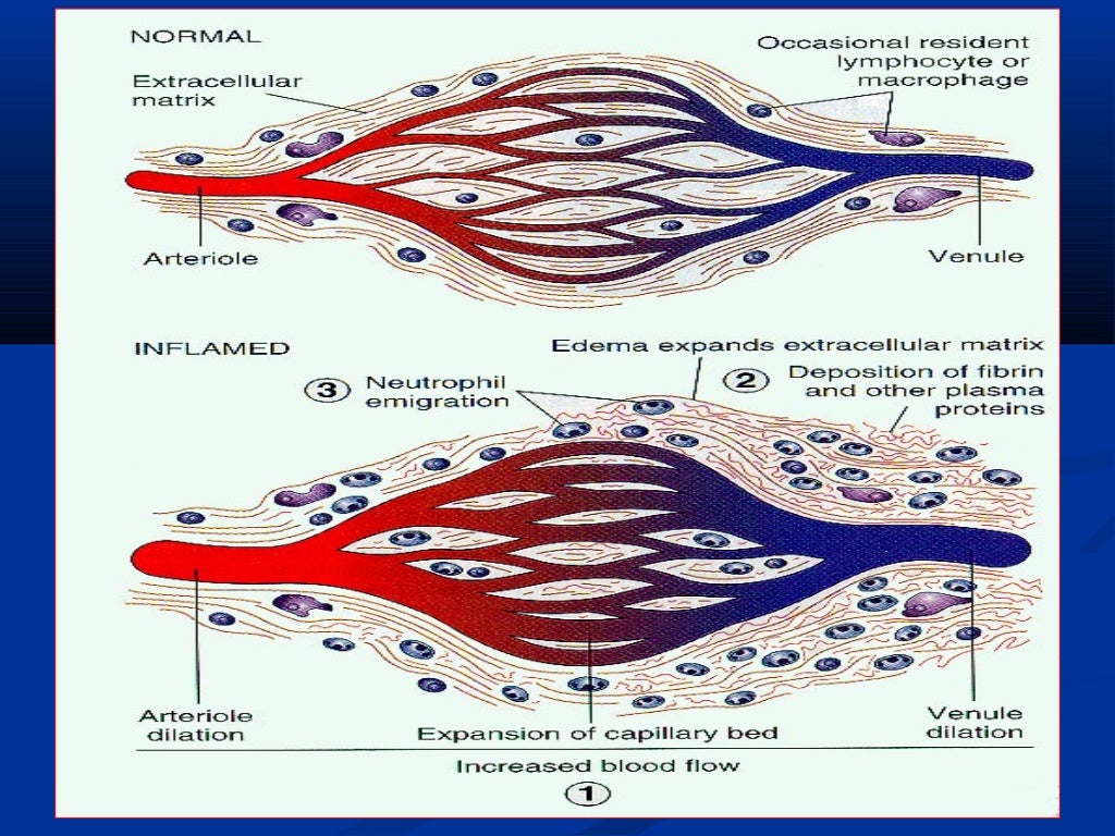 Acute inflammation