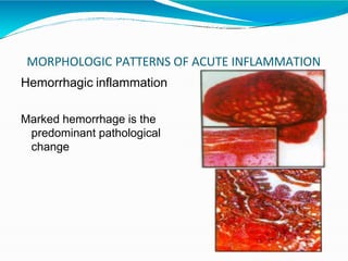 MORPHOLOGIC PATTERNS OF ACUTE INFLAMMATION
Hemorrhagic inflammation
Marked hemorrhage is the
predominant pathological
change
 