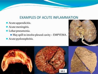EXAMPLES OF ACUTE INFLAMMATION
⚫ Acuteappendicitis.
⚫ Acute meningitis.
⚫ Lobarpneumonia.
⚫ Mayspill to involvepleural cavity – EMPYEMA.
⚫ Acutepyelonephritis.
 
