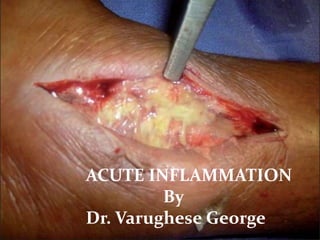 By
Dr.Varughese .P. George
Department of Pathology
ACUTE INFLAMMATION
By
Dr. Varughese George
 