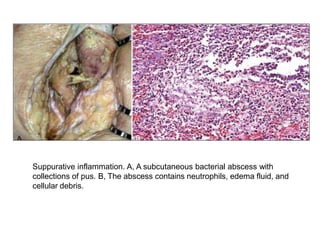 Morphologic Patterns of Acute
Inflammation –
ULCERS
 An ulcer is a local defect of the surface of an
organ or tissue that...
