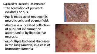 ACUTE INFLAMMATION, causes, mediators and other concepts | PPTX