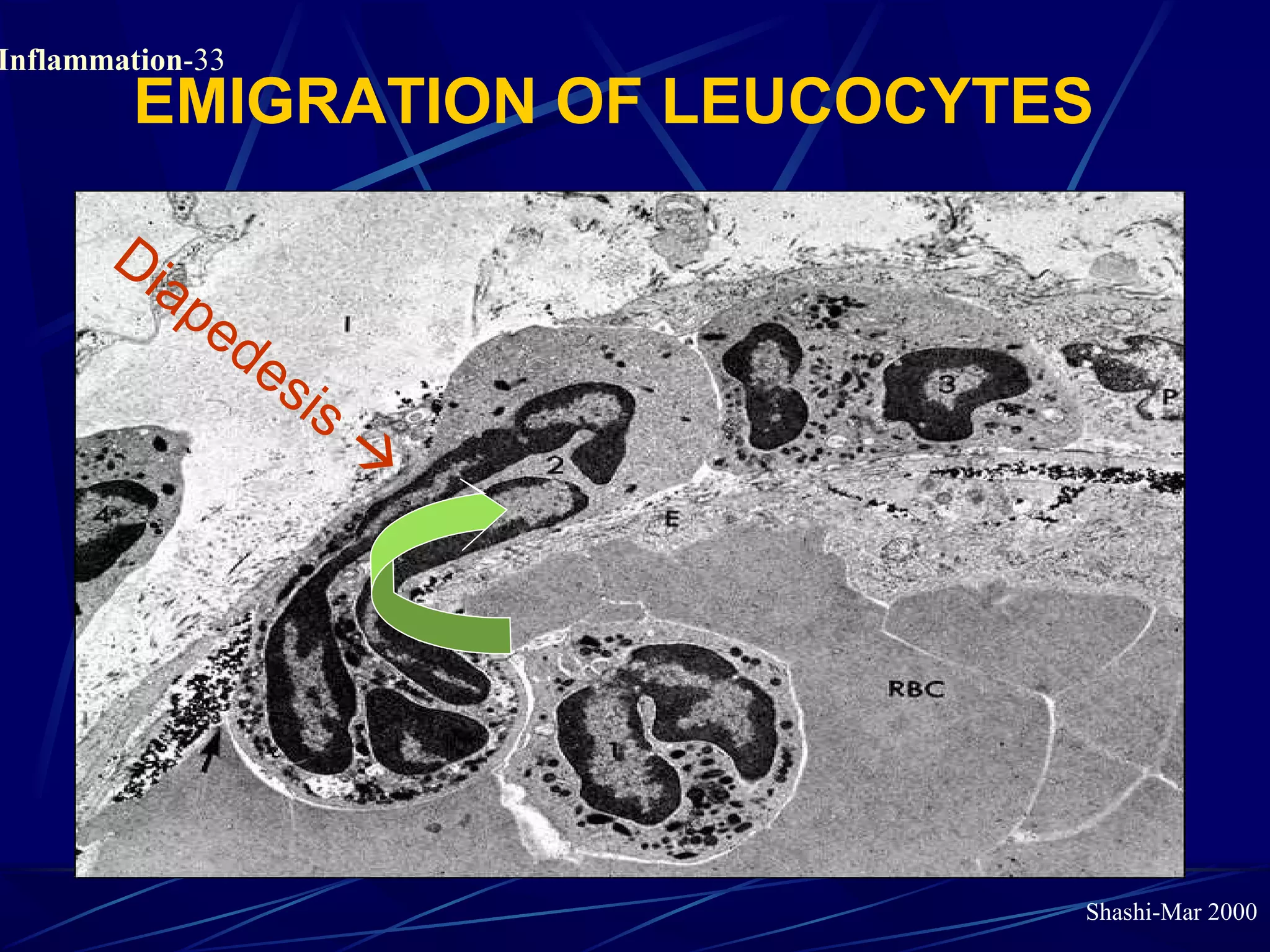 Shashi-Mar 2000
Inflammation-33
EMIGRATION OF LEUCOCYTES
Diapedesis 
 