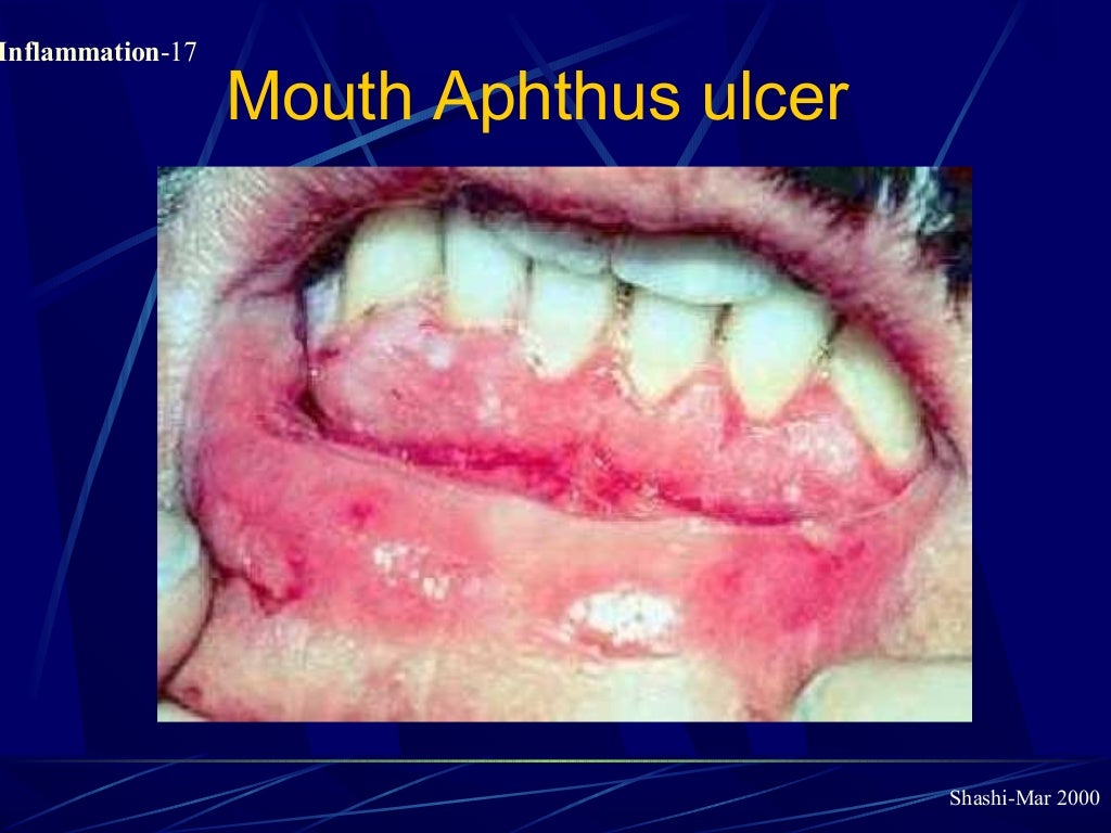 Pathology of Acute Inflammation