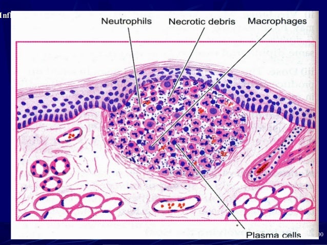Pathology of Acute Inflammation