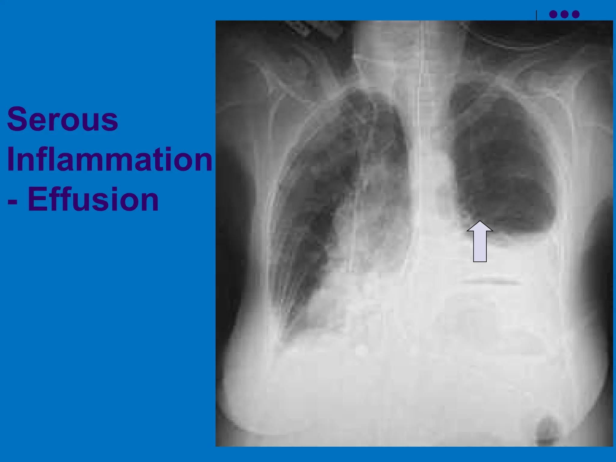 Serous
Inflammation
- Effusion
 