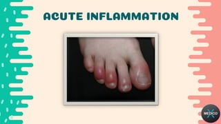 ACUTE INFLAMMATION
 