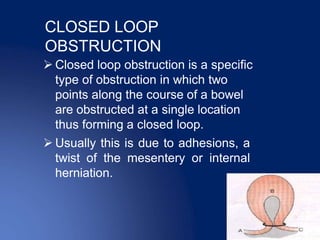 What Is Constriction Loop Acute intestinal obstruction | PPTX