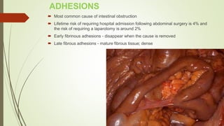 ADHESIONS
 Most common cause of intestinal obstruction
 Lifetime risk of requiring hospital admission following abdominal surgery is 4% and
the risk of requiring a laparotomy is around 2%
 Early fibrinous adhesions - disappear when the cause is removed
 Late fibrous adhesions - mature fibrous tissue; dense
 