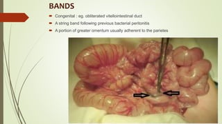 BANDS
 Congenital : eg. obliterated vitellointestinal duct
 A string band following previous bacterial peritonitis
 A portion of greater omentum usually adherent to the parietes
 