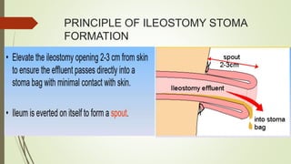 PRINCIPLE OF ILEOSTOMY STOMA
FORMATION
 