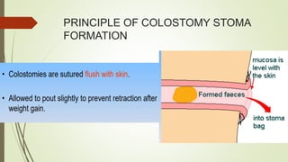 PRINCIPLE OF COLOSTOMY STOMA
FORMATION
 