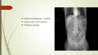  Abdominal Distension - marked
 Colicky pain is not a feature
 Effortless vomiting
 
