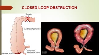 CLOSED LOOP OBSTRUCTION
 