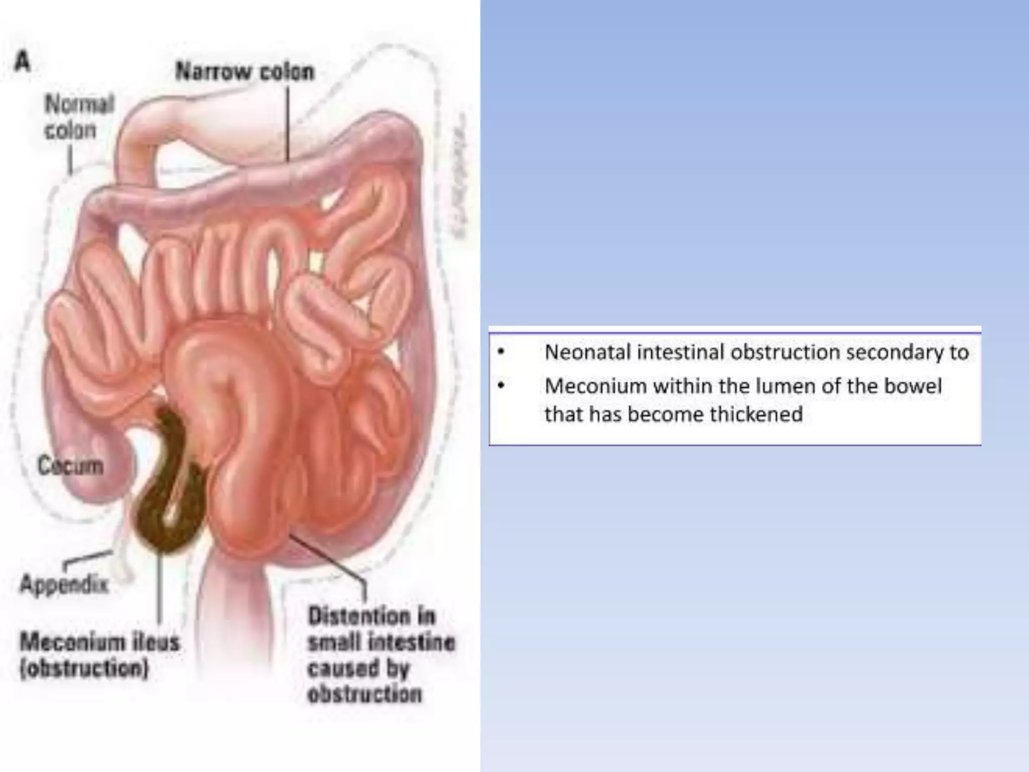 ACUTE INTESTINAL OBSTRUCTION.pptx