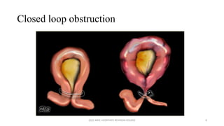 ACUTE INTESTINAL OBSTRUCTION- MDC 2025.pdf