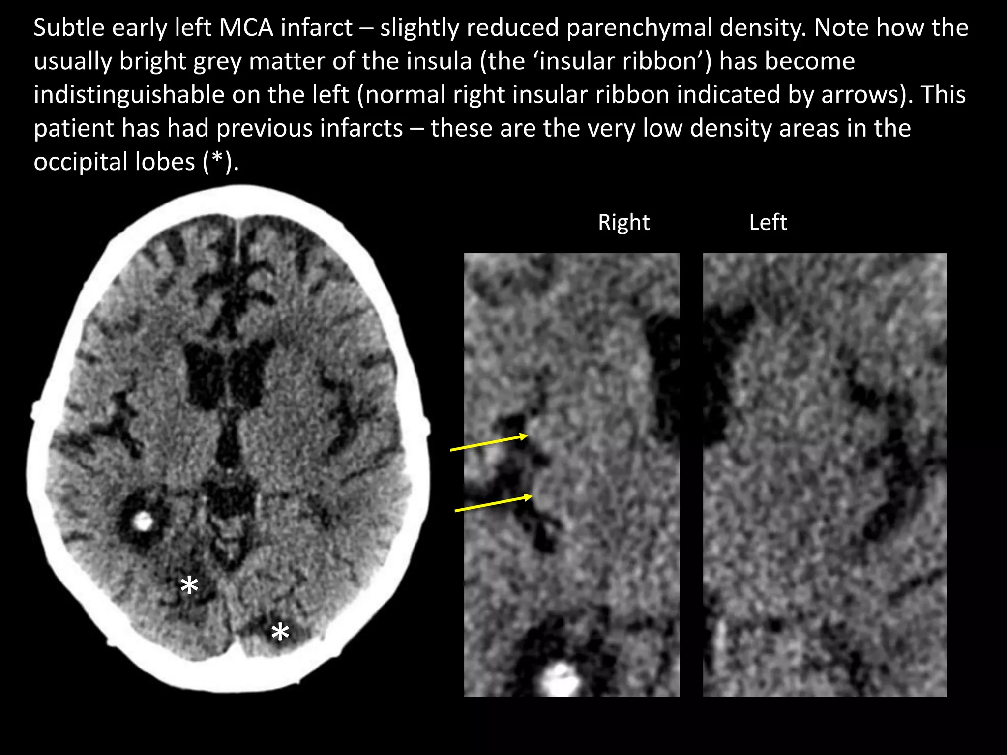 CT of acute intracranial pathology | PPTX