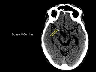Dense Mcs Sign CT of acute intracranial pathology | PPTX