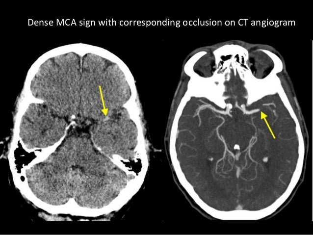 CT of acute intracranial pathology