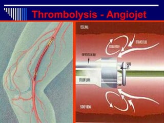 Acute ischaemia.ppt