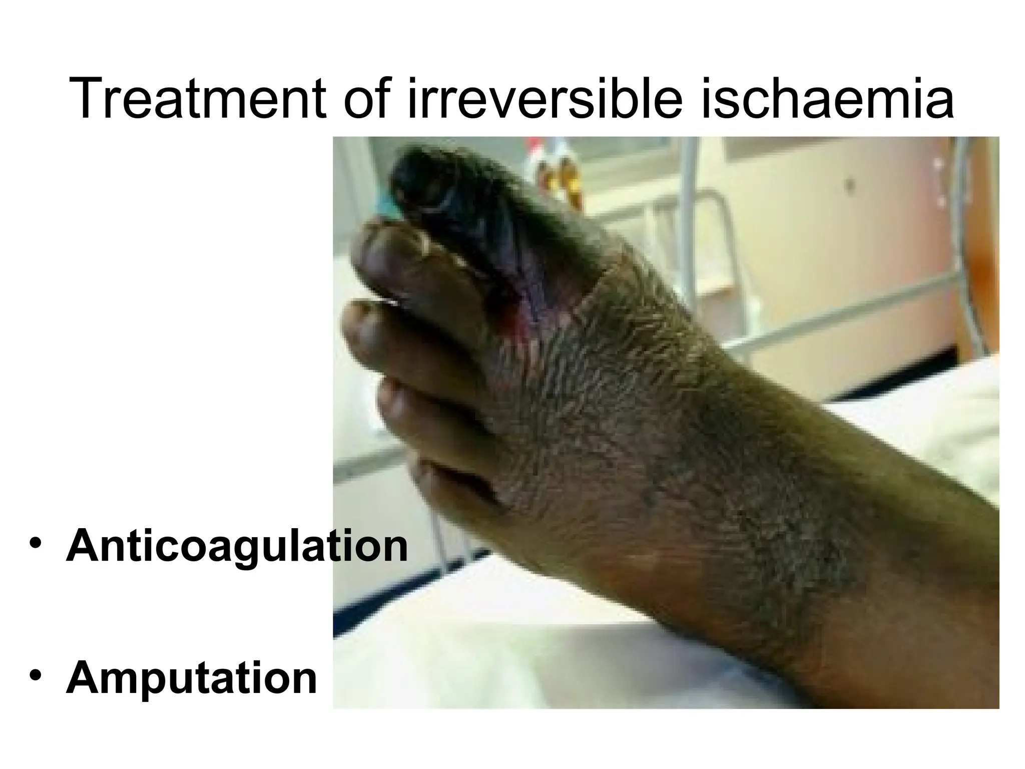 Acute Limb Ischemia - embolectomy, endovascular treatment, hybrid ...
