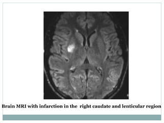 Brain MRI with infarction in the right caudate and lenticular region
 