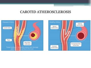 CAROTID ATHEROSCLEROSIS
 