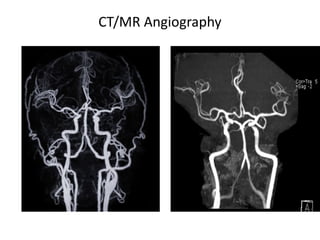 Comprehensive Management and Treatment of Acute Ischemic Stroke ...