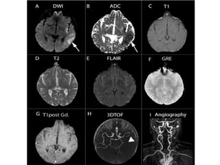 Comprehensive Management and Treatment of Acute Ischemic Stroke ...