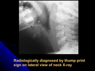 Radiologically diagnosed by thump print sign on lateral view of neck X-ray 